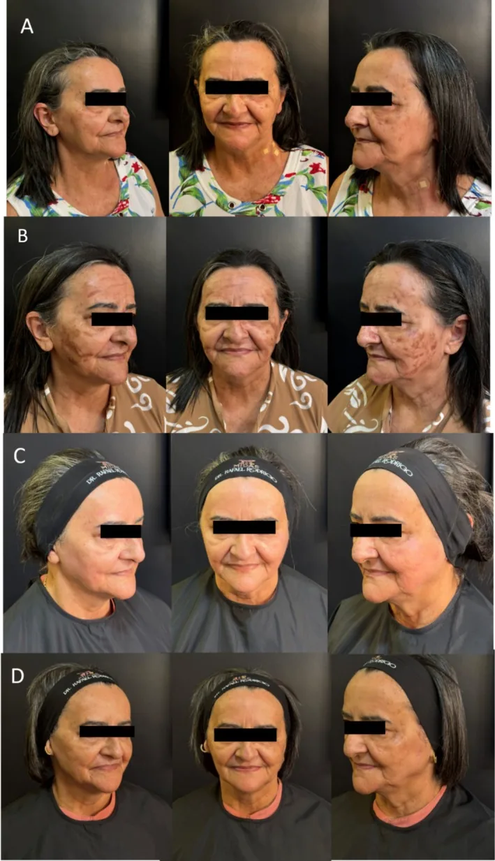 Photographs of a woman's face before a chemical peel, then severe post-inflammatory pigmentation after sun exposure, then improvement with a protocol including retinoic acid, the scientific name for tretinoin