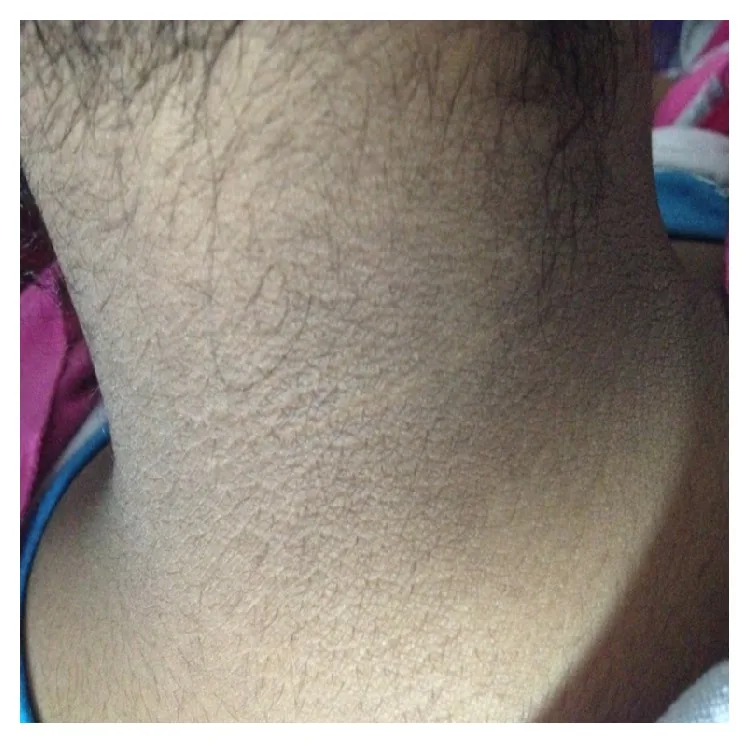 Dark, thickened, velvety skin in acanthosis nigricans linked to insulin resistance, a cause of dark underarms and neck that needs examination, not just a lightening cream