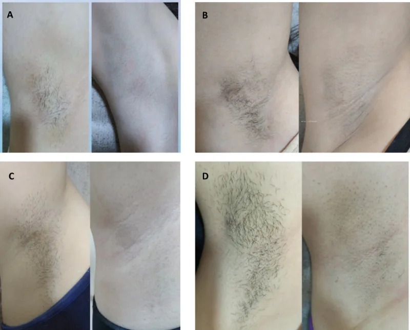 Several women's underarms before and after laser hair removal, with the grey shadow disappearing as the hair goes, a kind of dark underarm that needs no cream