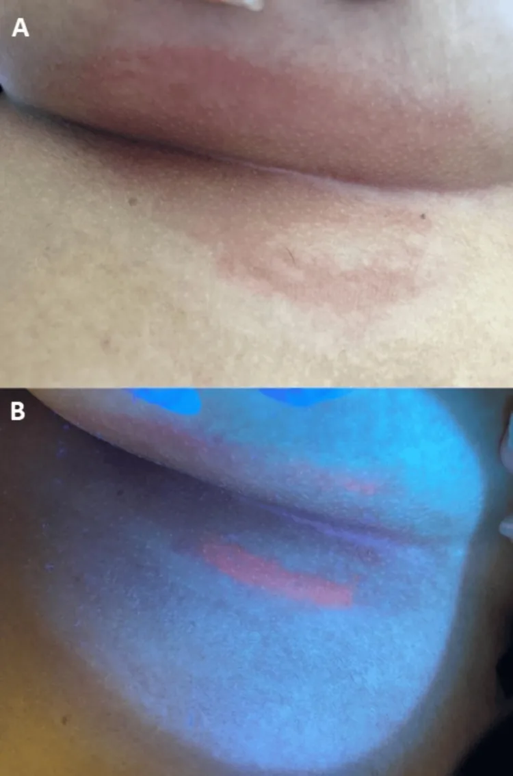 A reddish-brown patch in a skin fold under normal light, then glowing coral-red under a Wood's lamp in erythrasma, a cause of dark underarms treated with an antibiotic