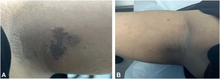 An underarm with a well-defined dark brown patch surrounded by small bumps, and another with scattered dark patches after laser hair removal, a rare cause of dark underarms